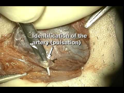 Microsurgical Subinguinal Varicocelectomy 