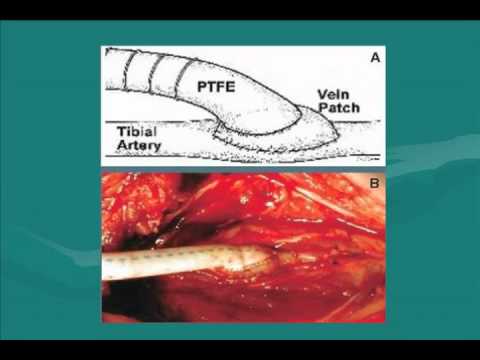 Surgical Approaches for Peripheral Arterial Disease (PAD)