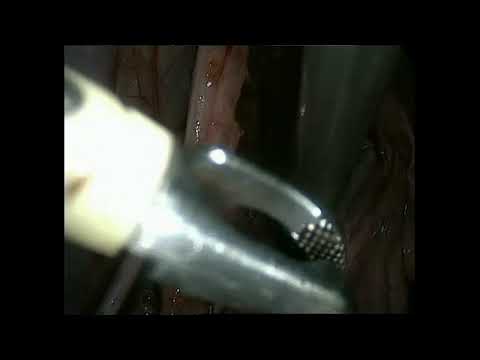 Radical Trachelectomy for Cervical Cancer