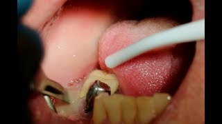 Explosive Drainage of Pus from a Dental Abscess