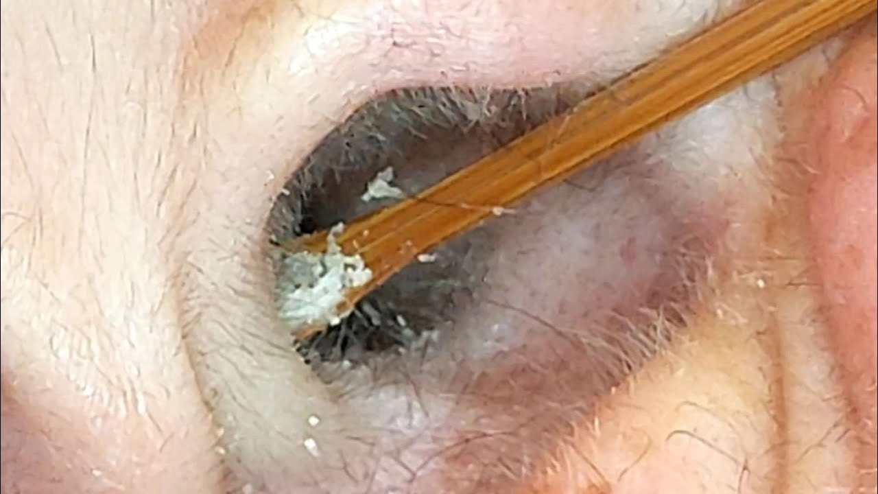 #161  〜テスト投稿【耳中カメラ映像】アリ//賛？否？〜