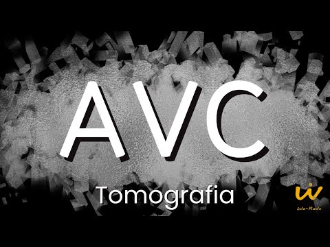 AVC ISQUÊMICO - Crônico e Agudo na Tomografia de Crânio
