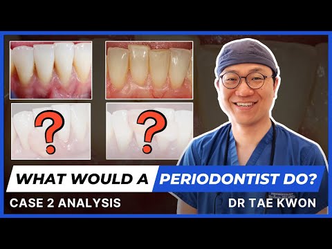 Co zrobiłby periodontolog? - przypadek kliniczny nr 2