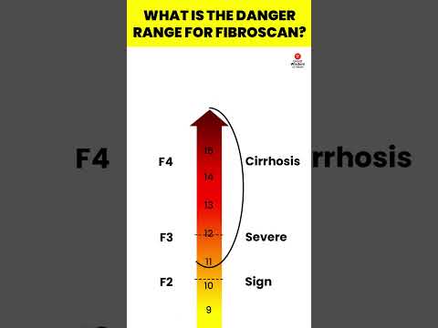What is the danger range for FibroScan | Fibroscan | Liver Fibrosis Treatment  #viral #hepatitis