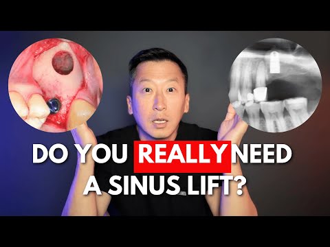 Sinus Lift 101: Lateral vs. Vertical Approach, Bruxism Impact & Must-Know Bone Graft