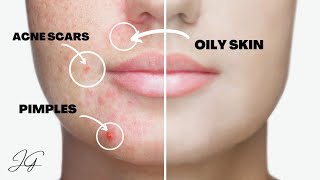 5 Skin Imperfections You Can Fix Overnight | Get Rid Of Acne Scars, Oily Skin, Pimples & MORE!