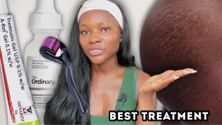 The best treatment for stretch marks ever! | How to clear stretch marks fast at home #stretchmarks