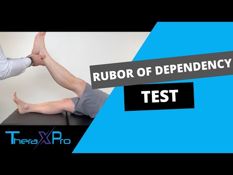 Rubor of Dependency Test | Buerger's | Peripheral Arterial Disease