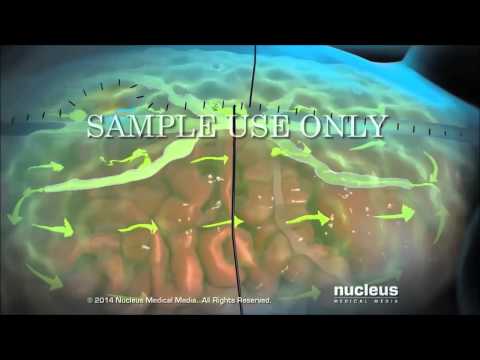 Hyperthermic intraperitoneal chemotherapy