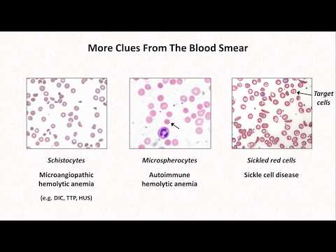 Anemia: Lesson 4 - Clues From the Blood Smear