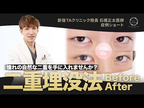 重ため”一重”を左右揃ったナチュラル”二重”に!【二重埋没 症例】