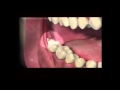 Как происходит удаление зуба 