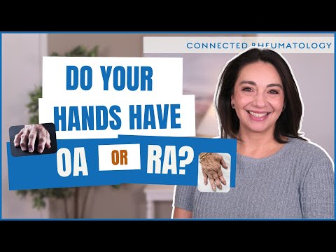5 Signs Your Hand Pain Needs a Rheumatologist