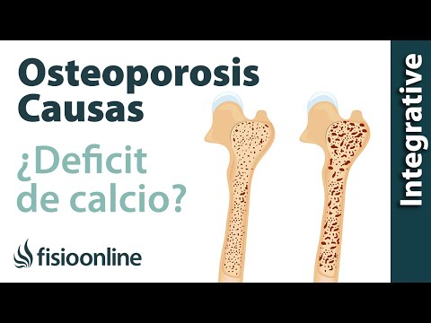 Verdadera relación entre la falta de calcio y la osteoporosis