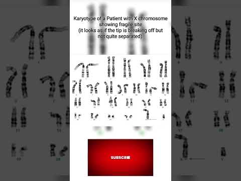 Rare Abnormal Karyotype #genetics #laboratory #science #shorts #biology #phd