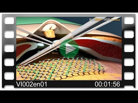 DynaMesh®-CICAT - Animation: Umbilical Hernia Repair in PUMP Technique