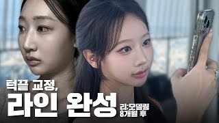 리;모델링 — 8개월 후, 얼굴라인이 이렇게 자리 잡았다 (수술 후 인터뷰)ㅣ비티성형외과