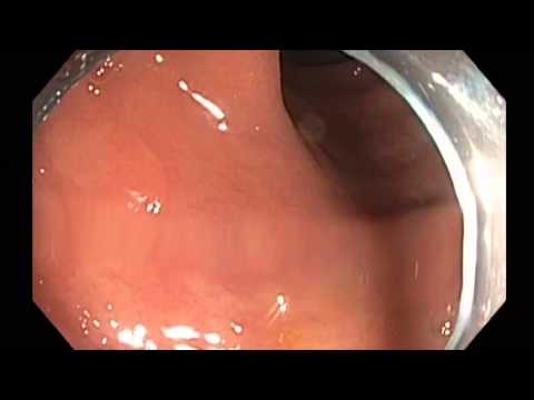 Chromoendoscopy - Multiple Subtle Flat Lesions