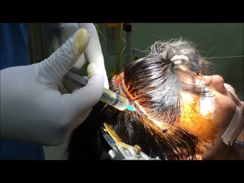 Preoperative Part Preparation (PPP) Method