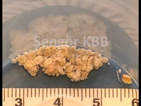 Sialolithiasis-Salivary stone treatment with sialendoscopic pneumatic lithotripsy