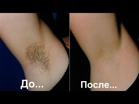 Как избавится от пигментных старческих пятен Презентация о веснушках