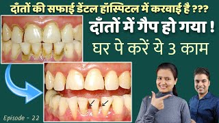 teeth gap after cleaning | teeth gap home remedy | दांतों की सफाई | Episode – 22