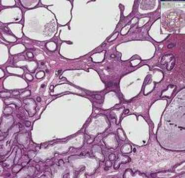 Histopathology Colon--Juvenile polyp
