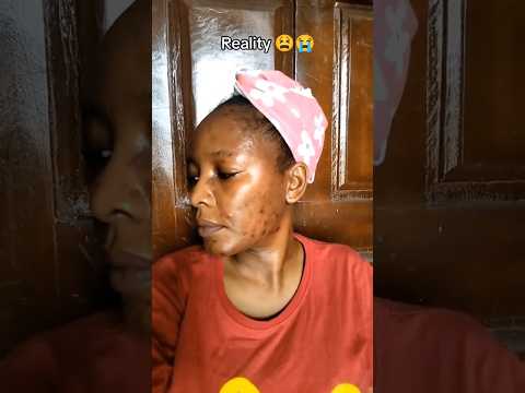 Using Tretinoin gel: Expectations VS Reality 😫#skincare #acne #oilyskin #acnescars #tretinoin
