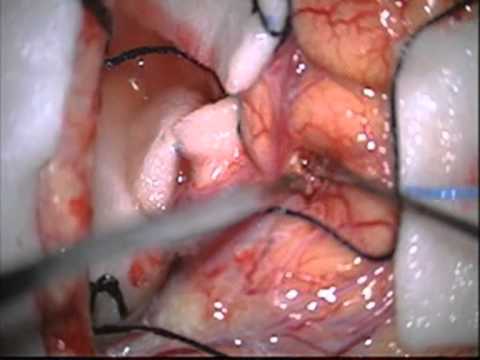 Αρτηριοφλεβώδης Δυσπλασία (AVM)