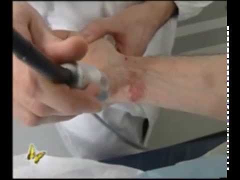 Psoriasi di precancro della pelle Come psoriasi in piaceri di Kazakhstan