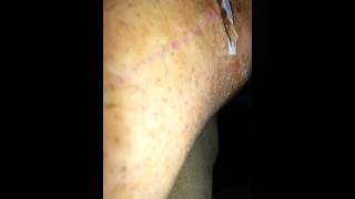 Scab removal