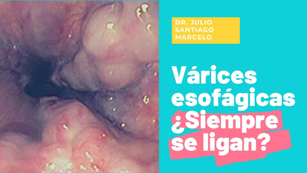 Watch Várices esofágicas ¿siempre se deben ligar Now Várices esofágicas ¿siempre se deben ligar