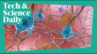 Download lagu Alzheimer’s disease drug breakthrough ...Tech & Science Daily #podcast mp3 Download lagu Alzheimer’s disease drug breakthrough ...Tech & Science Daily #podcast mp3