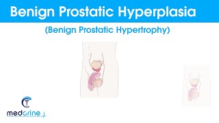 overview of benign prostate hyperplasia (BPH)