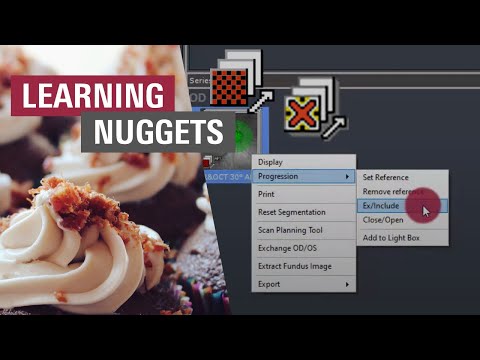 🇩🇪 Glaukom Verlaufskontrolle – Änderungen erkennen, Referenz verstehen | SPECTRALIS