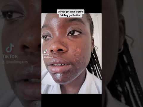 My 6 month accutane journey in 22 seconds! #shorts