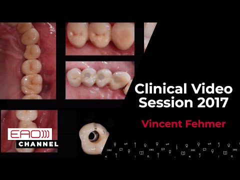 Implant - bone reconstruction a contemporary approach w Vincent Fehmer | Clinical Video Session 2017