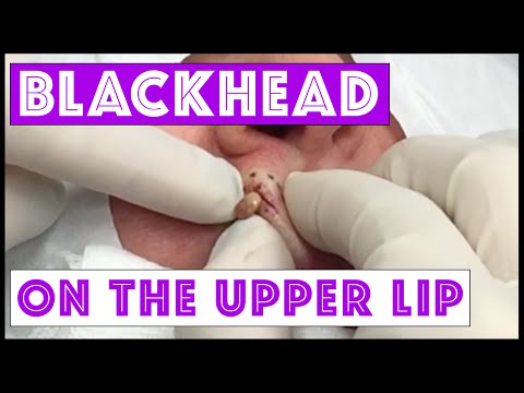 Can you spot this Blackhead? Extracted on the Upper Lip