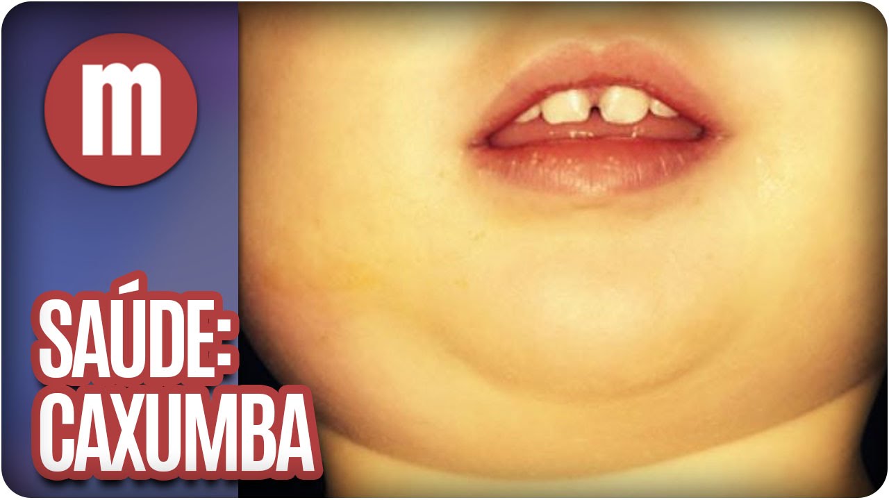 Mulheres - Saúde: Caxumba (17/05/16)
