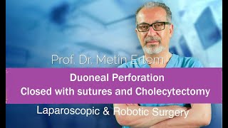 Miniaturka - Duodenal Perforation. Closed with sutures & Cholecystectomy. Metin Ertem MD.FACS.