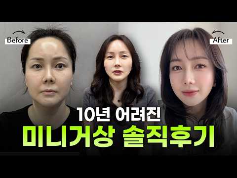 40대미니거상후기, 엄마가 아닌 나를 다시 찾고 싶었어요!ㅣ디에이성형외과ㅣ40대미니거상회복후기