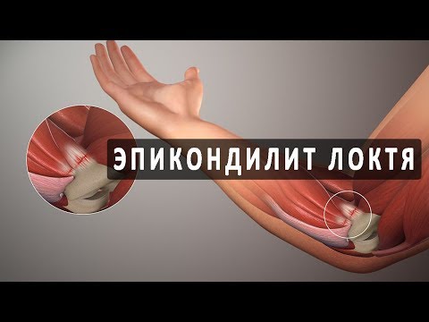 Что такое эпикондилит локтевого сустава?