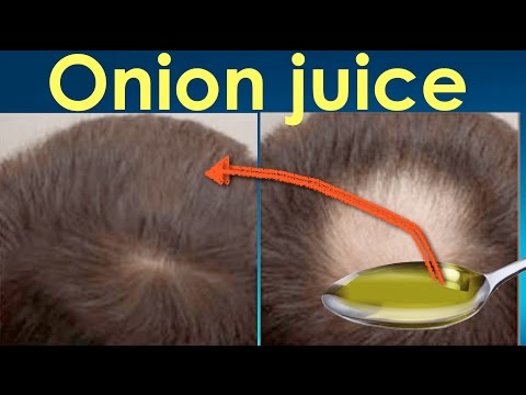 Onion juice for hair regrowth before and after/ Onion juice results for hair  regrowth and hair loss | CaptionsMaker - subtitles editor for YouTube