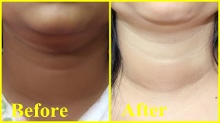Dark Neck Don&#39;t Worry - Miracle Remedy to get Fair Neck/ 100% Effective Natural Home Remedy