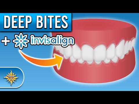Can Invisalign Fix Deep Bites?
