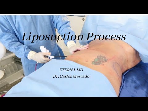 Liposuction | Eterna MD Medical Rejuvenation Center |...