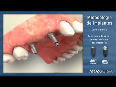 Reposición de varios dientes mediante dos implantes