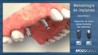 Reposición de varios dientes mediante dos implantes