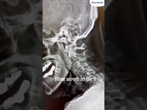 Can Paralysis be reversed ? cervical spine compression treated with ACDF