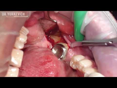 Удаление ретенированного зуба 38, анкилоз